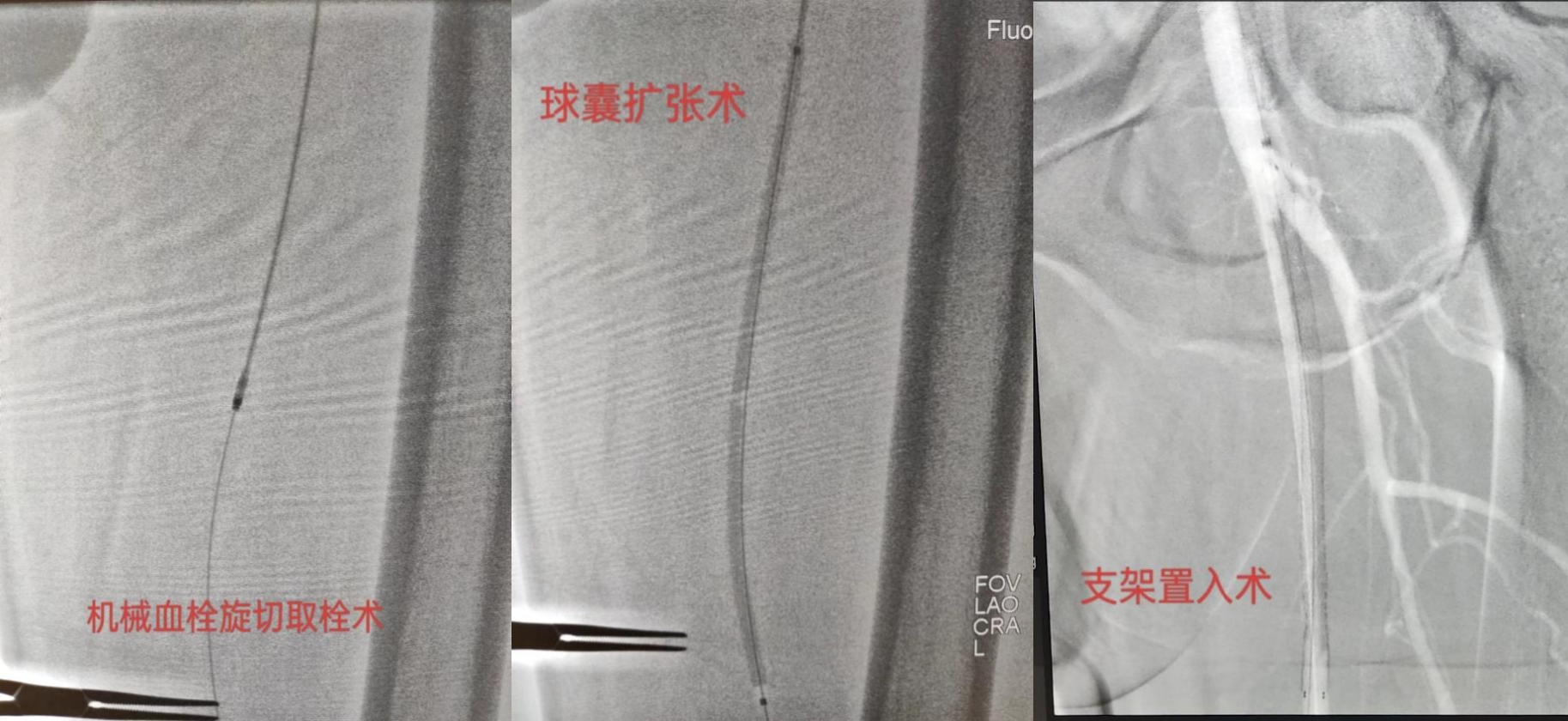 知“足”方能常乐——我院成功完成首例下肢动脉慢性闭塞开通手术