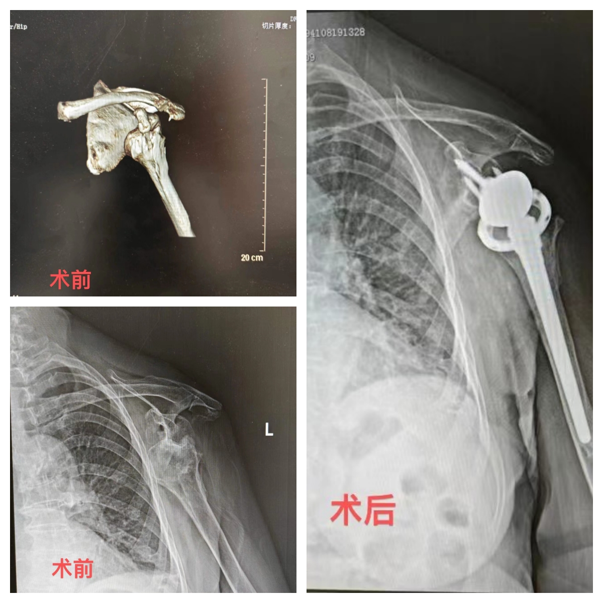 反肩置换手术，“报废”的肩关节重获新生